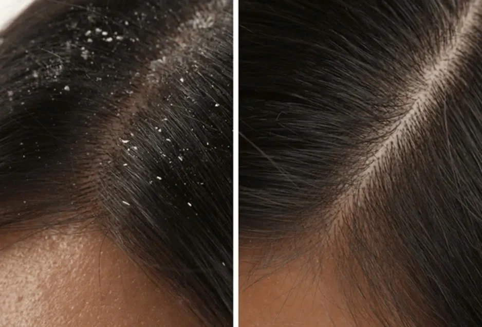 Bí quyết trị gàu: Chăm sóc da đầu từ gốc