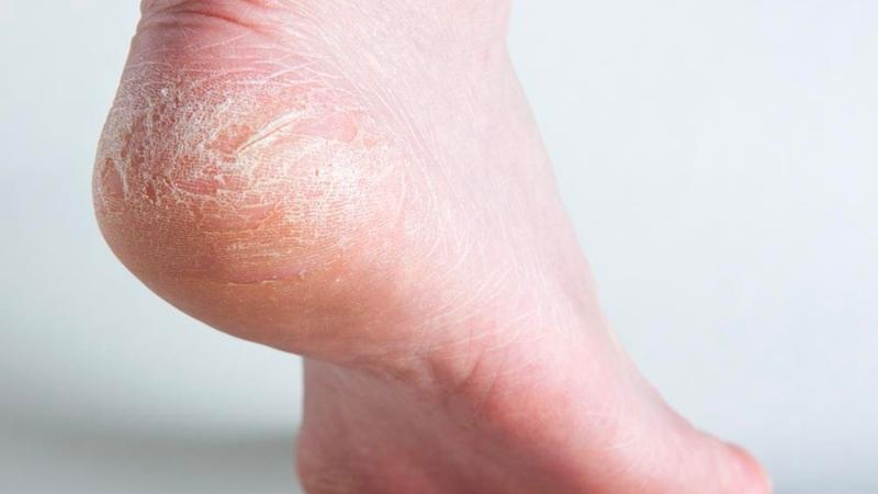 Bị nứt gót chân: Nguyên nhân, triệu chứng, cách trị hiệu quả